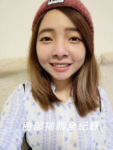 自體脂肪全臉補脂全紀錄 (夫妻宮、淚溝、下巴)