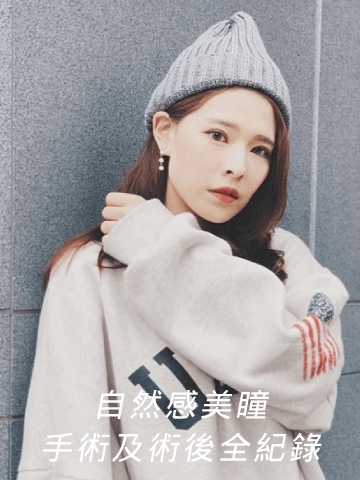 割雙眼皮&開眼頭 自然感美瞳再放大