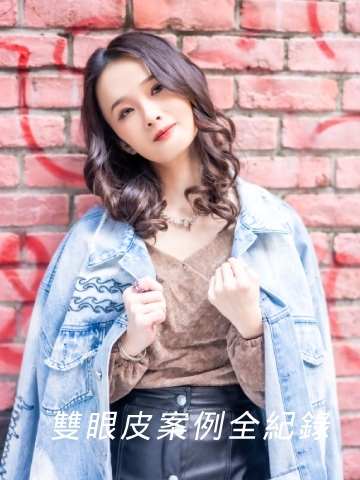 【雙眼皮手術】割雙眼皮／縫雙眼皮實例見證全收錄