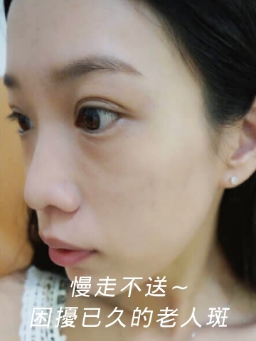 淨膚雷射~斑點、老人斑通通OUT！！原生肌膚再現