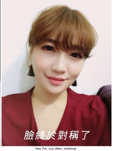 玻尿酸改善大小臉 拯救歪臉人