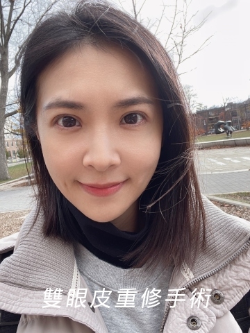 割雙眼皮失敗想重修？陳志軒醫師改善大小眼不對稱問題