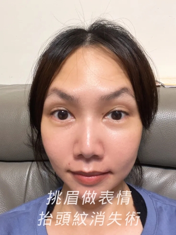 困擾的抬頭紋 持續施打彩虹肉毒除皺、瘦臉 ┃中山淨妍醫美診所