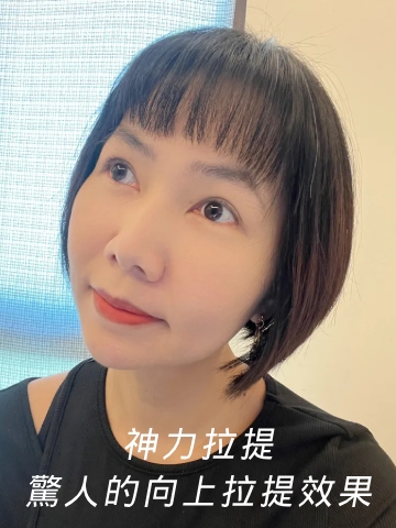 神力拉提 MINT LIFT秘特拉提線 埋線拉提效果超讚 │ 板橋醫美