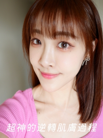 靠液態電波逆轉肌膚生命力_Profhilo逆時針