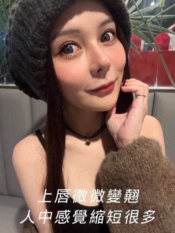 艾玻玻尿酸豐唇，改善上唇偏薄，影響人中看起來變長的困擾