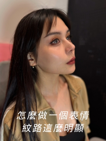 做表情紋路都跑出來，德瑪芙玻尿酸填補法令紋凹陷，紋路變得不明顯了