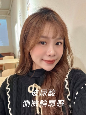 玻尿酸法令紋、改善疲累臉，玻尿酸下巴、打造側臉的輪廓感