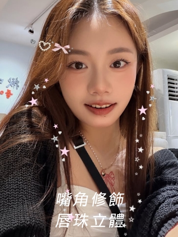 玻尿酸嘴唇，嘴角修飾、唇珠立體，一點小改變就能影響臉部整體