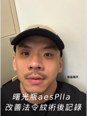 曙光瓶aesPlla 首次施打術後心得記錄｜ 改善法令紋、臉部凹陷