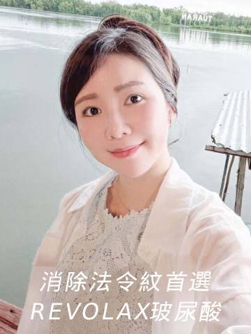 拉芙麗玻尿酸｜讓玻尿酸來解決鼻基底凹陷，消除法令紋
