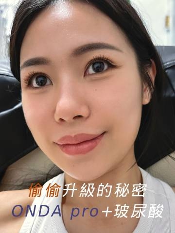 ONDA pro+艾波玻尿酸｜偷偷升級，側臉線條+嘟嘟唇一次擁有