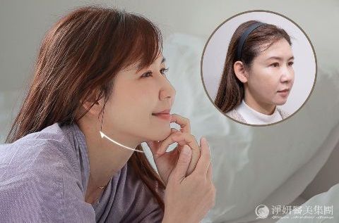 鳳凰電波拉皮（900發）-忠孝淨妍診所案例