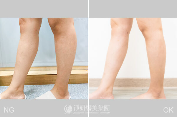 抽脂小腿效果對比明顯，由周哲宇醫師於中山淨妍醫美診所施做