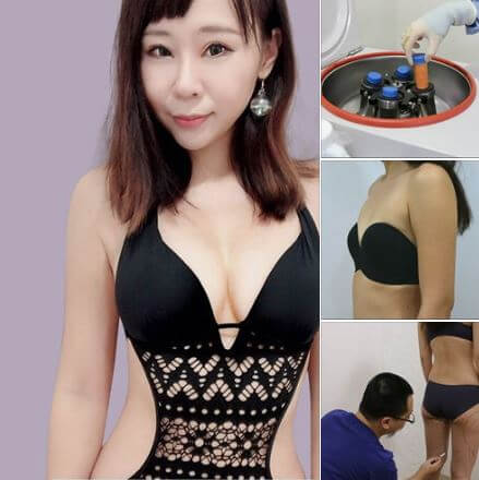 抽脂效果收脂案例抽脂豐胸隆乳自體脂肪豐胸隆乳效果怎麼樣