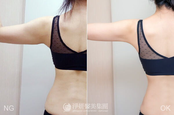 抽脂瘦手臂、副乳、後腰的真實案利，由殷紹閔醫師於高雄淨妍醫美診所操刀