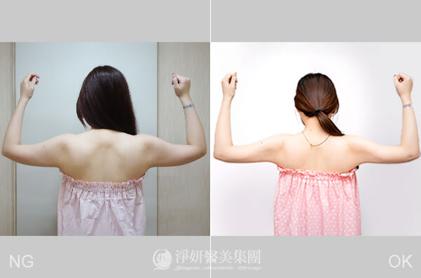 抽脂瘦手臂的效果對比，由殷紹閔醫師於高雄淨妍醫美診所操刀