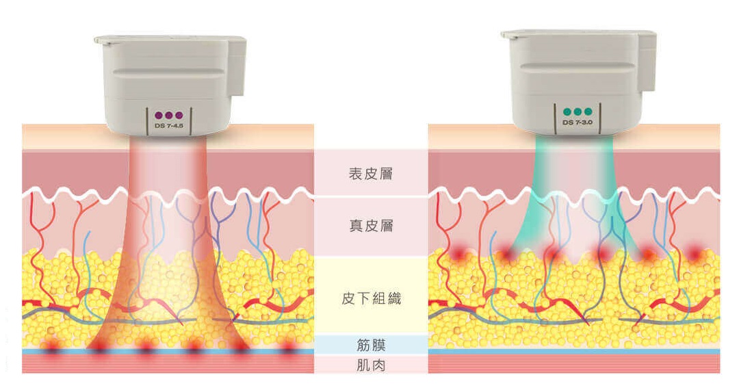 極線音波使膠原蛋白增生,達到緊緻拉提效果