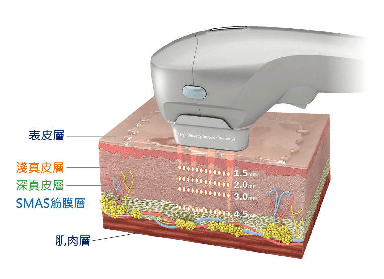 海芙音波拯救鬆弛老化,刺激膠原蛋白增生