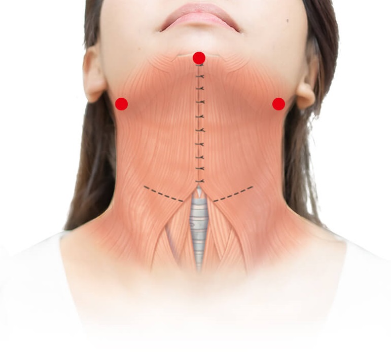 消除雙下巴打造天鵝頸靠下巴抽脂和括頸肌縫合術