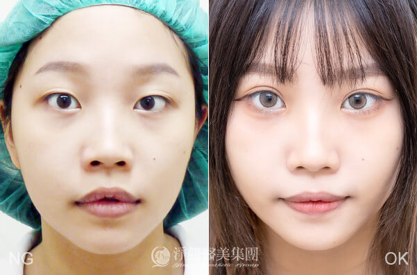 縫雙眼皮術後案例，由周哲宇醫師於高雄淨妍醫美診所操刀
