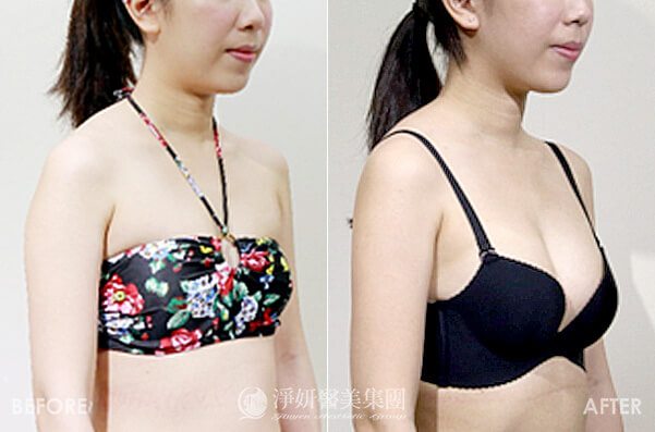 自體脂肪隆乳(淨妍醫美診所(高雄)案例)