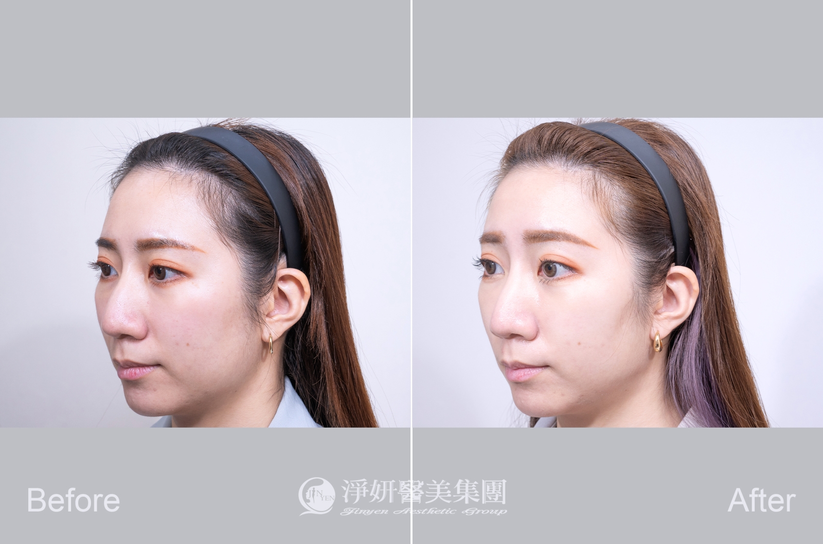 4D舒顏萃聚左旋乳酸  (淨妍醫美診所(忠孝)案例)  