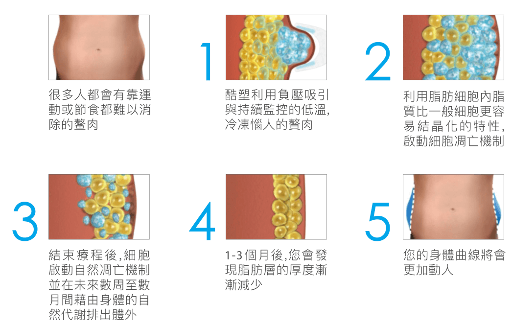 酷塑冷凍減脂瘦身原理介紹