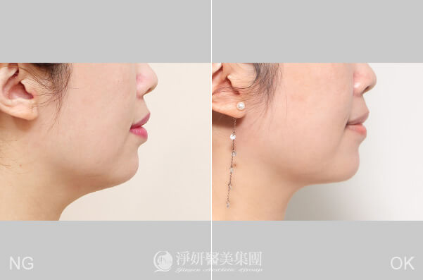 酷塑改善雙下巴(淨妍醫美(忠孝)案例) 
