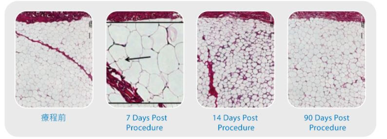 酷塑冷凍減脂療程組織切片