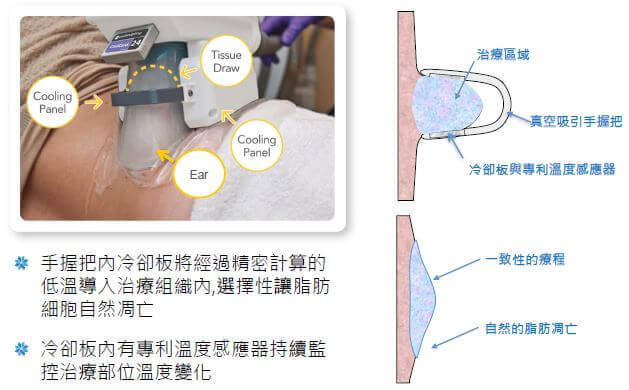 酷塑冷凍減脂真空吸力手把