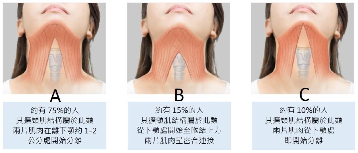 雙下巴成因和天生擴頸肌結構有關
