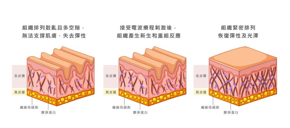 電波拉皮可刺激膠原蛋白增生、重組