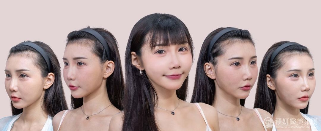 淨妍醫美韓國十蓓電波10THERMA案例分享
