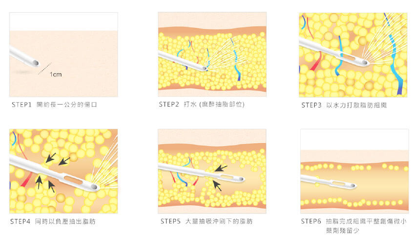 水刀抽脂-微粹脂手術原理