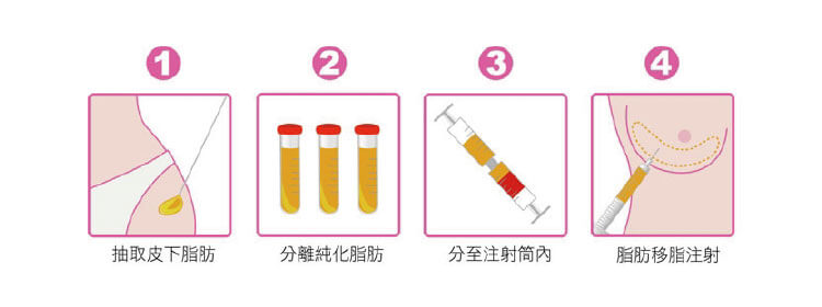 自體脂肪移植手術四大步驟