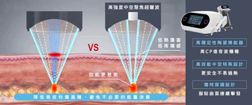 彩蝶音波拉提(優提斯音波拉提)UTIMS 特色優勢