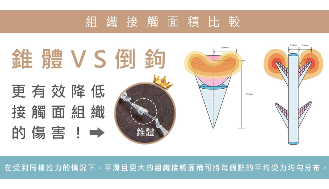 塑立愛立提線(少女線)療程特點