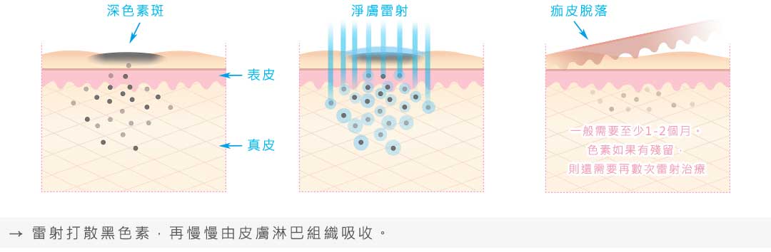 淨膚雷射如何有效打擊黑色素？