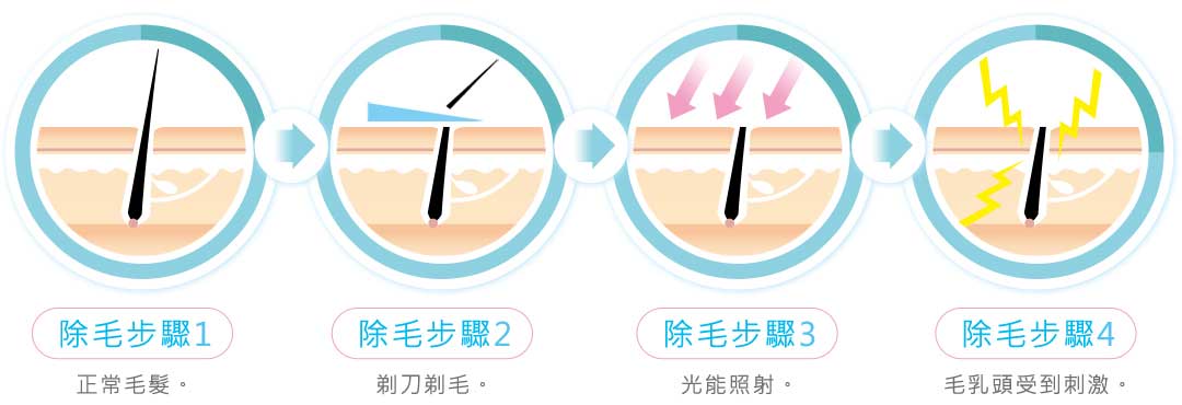 雷射除毛步驟原理