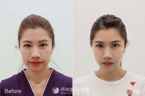 Q+立線音波 (淨妍醫美案例)