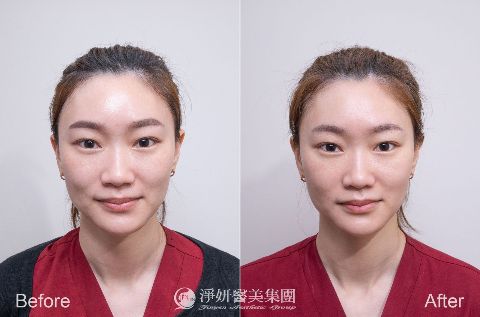 Q+立線音波 (淨妍醫美案例)