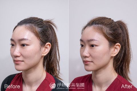 Q+立線音波 (淨妍醫美案例)