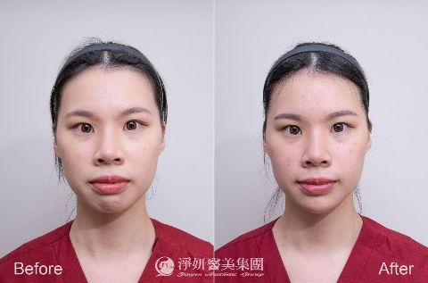 Q+立線音波 (淨妍醫美案例)