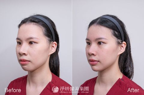 Q+立線音波 (淨妍醫美案例)
