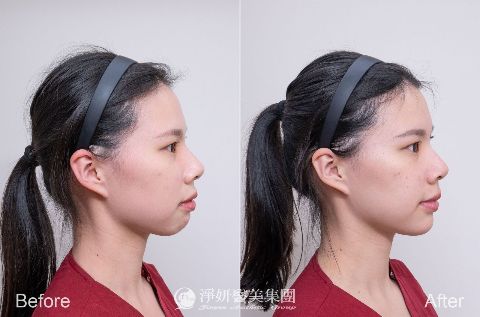 Q+立線音波 (淨妍醫美案例)