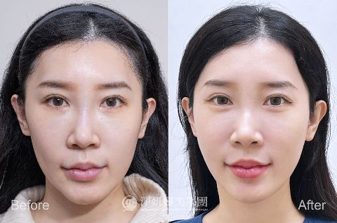 薇貝拉（俗稱魔法針）在dcard、ptt都是熱門討論的療程，市面上這麼多膠原蛋白增生劑，薇貝拉到底有什麼特別之處呢？