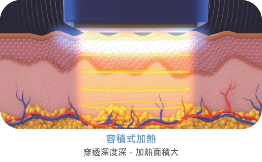 迎接歲月挑戰就靠它！  醫：十蓓電波緊實效果佳