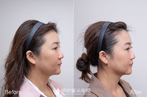 十倍電波術後效果