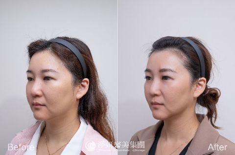 十倍電波術後效果